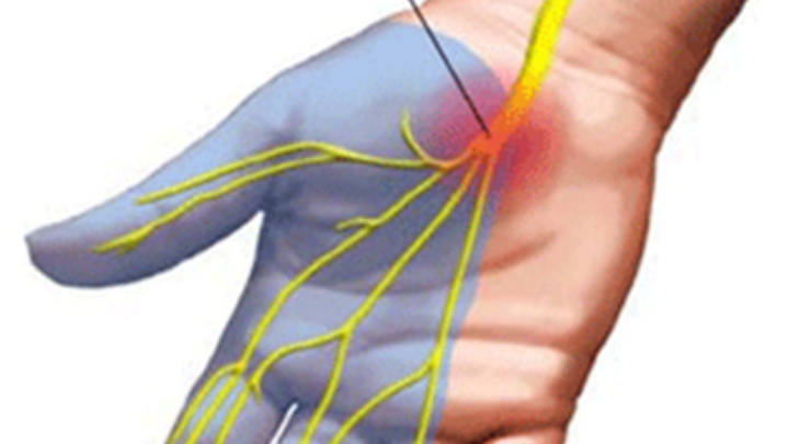 Σύνδρομο καρπιαίου σωλήνα